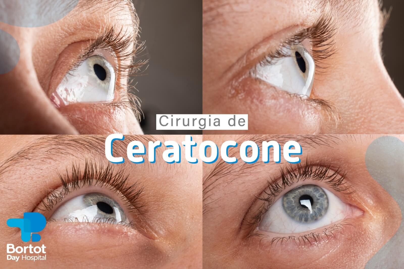 Cirurgia de Ceratocone (Anel de Ferrara)