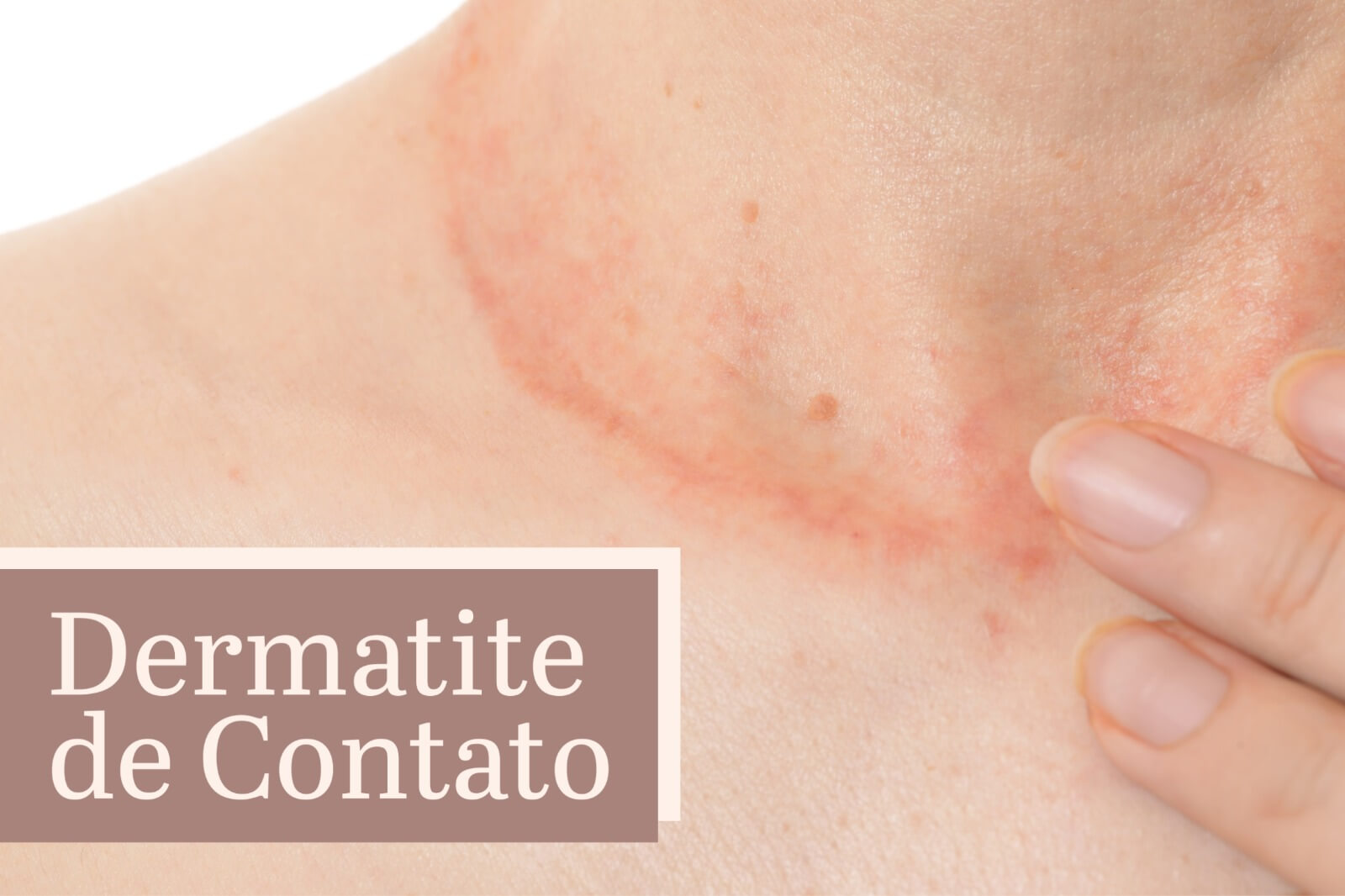 Dermatite de contato