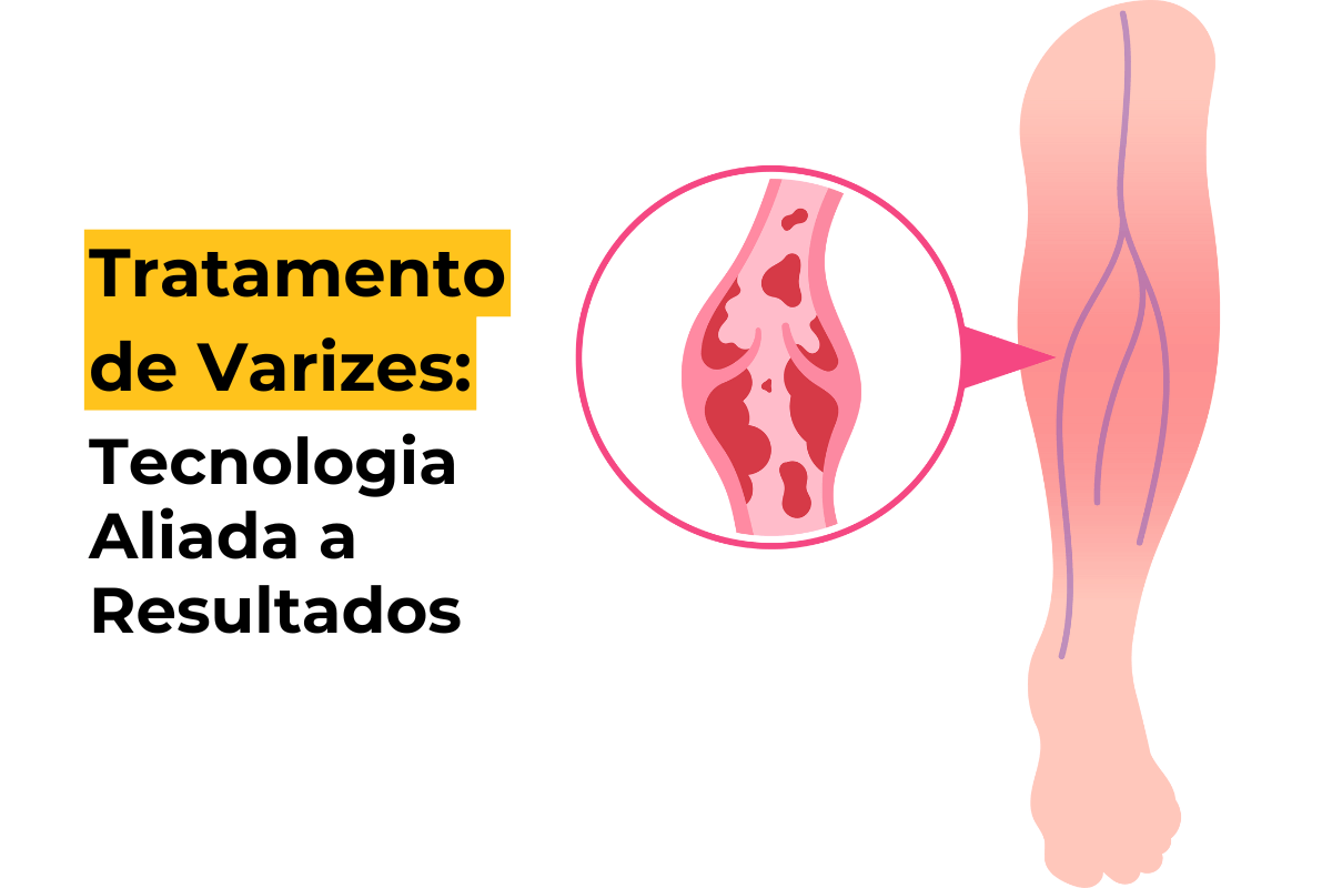 Tratamento de Varizes em Botafogo: Tecnologia Aliada a Resultados