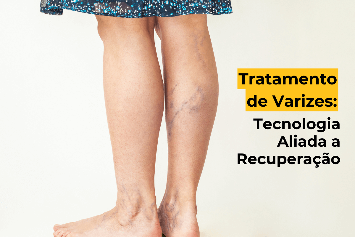 Tratamento de Varizes em Maringá: Tecnologia Aliada a Recuperação
