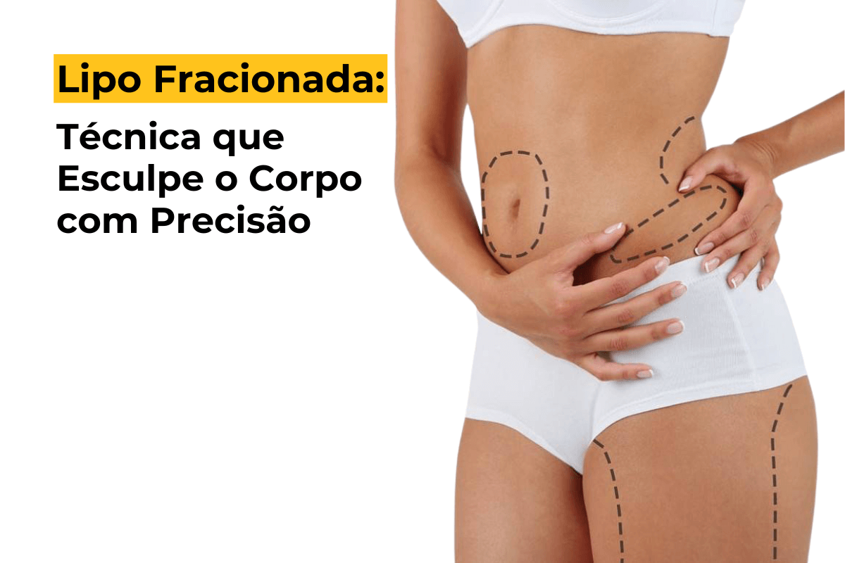 Lipo Fracionada em Maringá: Técnica que Esculpe o Corpo com Precisão