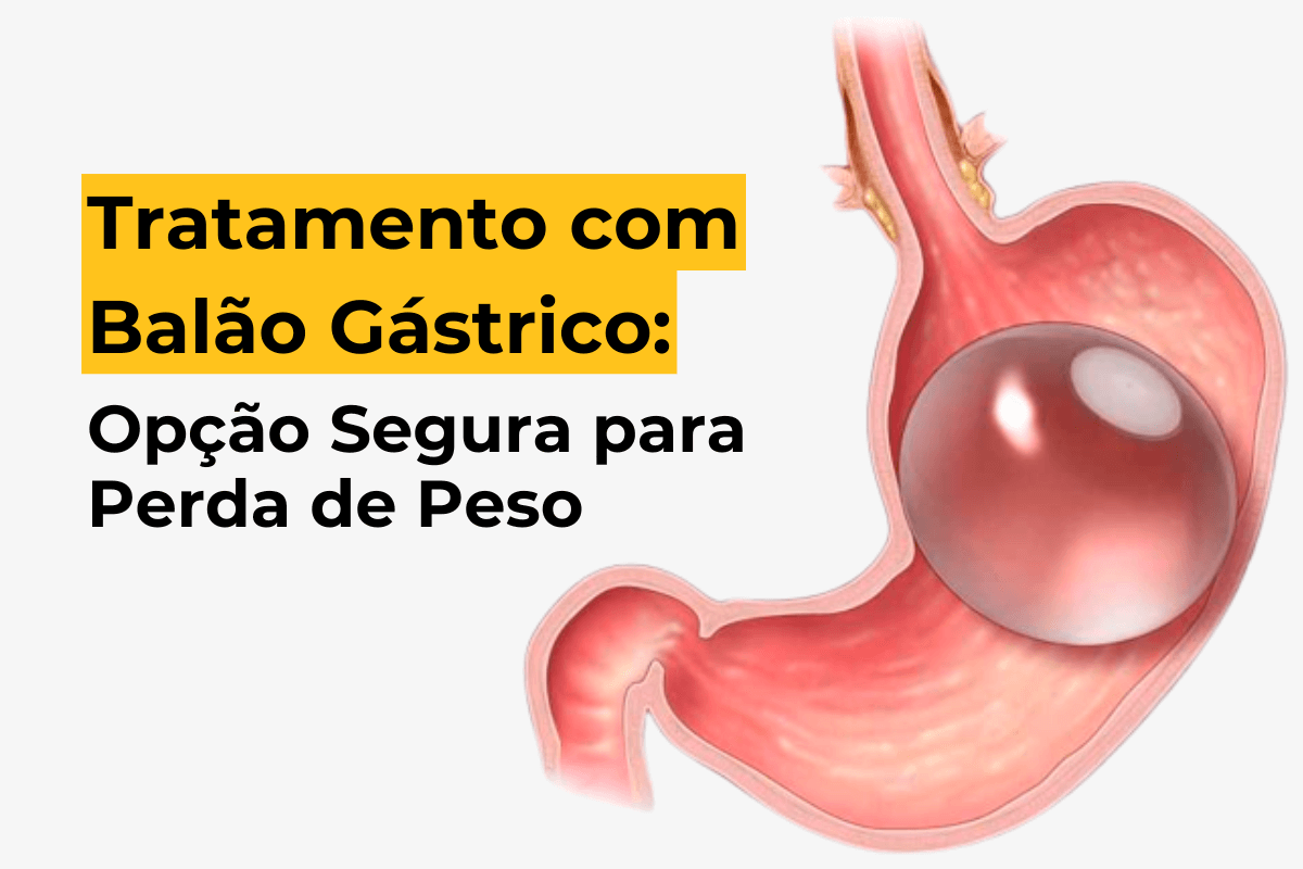 Tratamento com Balão Gástrico em Maringá: Opção Segura para Perda de Peso