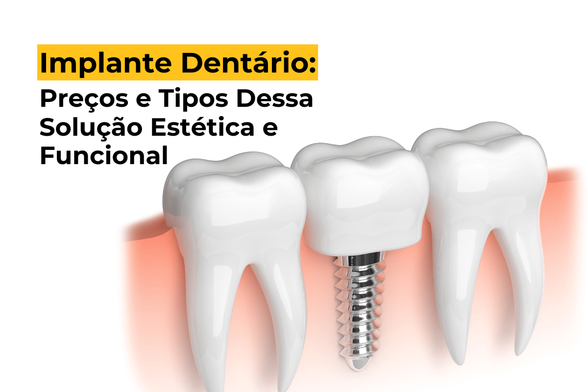 Implante Dentário em Maringá: Preços e Tipos Dessa Solução Estética e Funcional