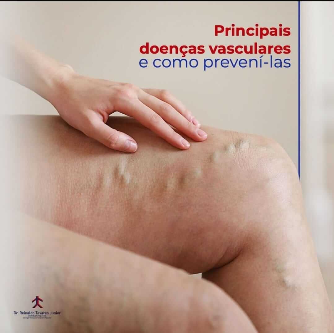 Principais doenças vasculares e como prevení-las