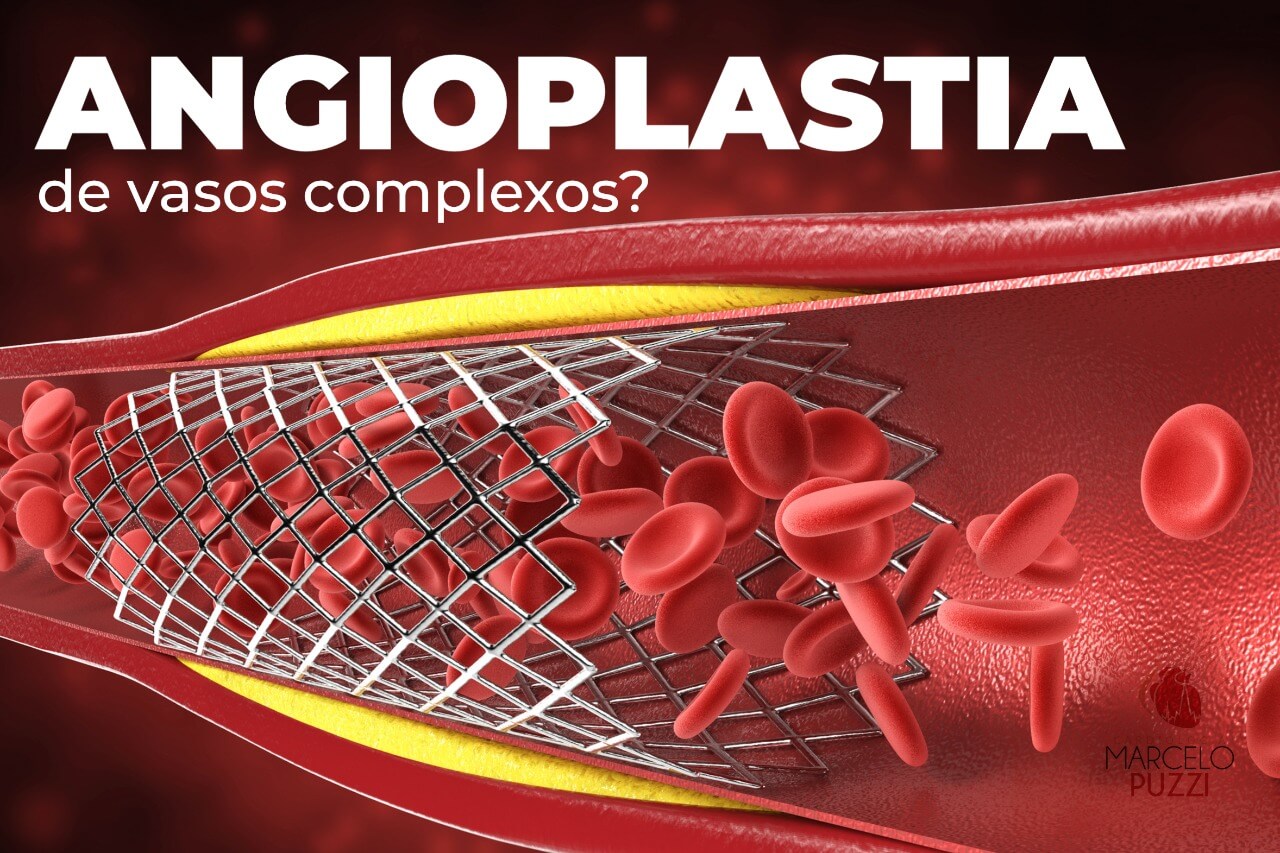 Angioplastia de vasos complexos 