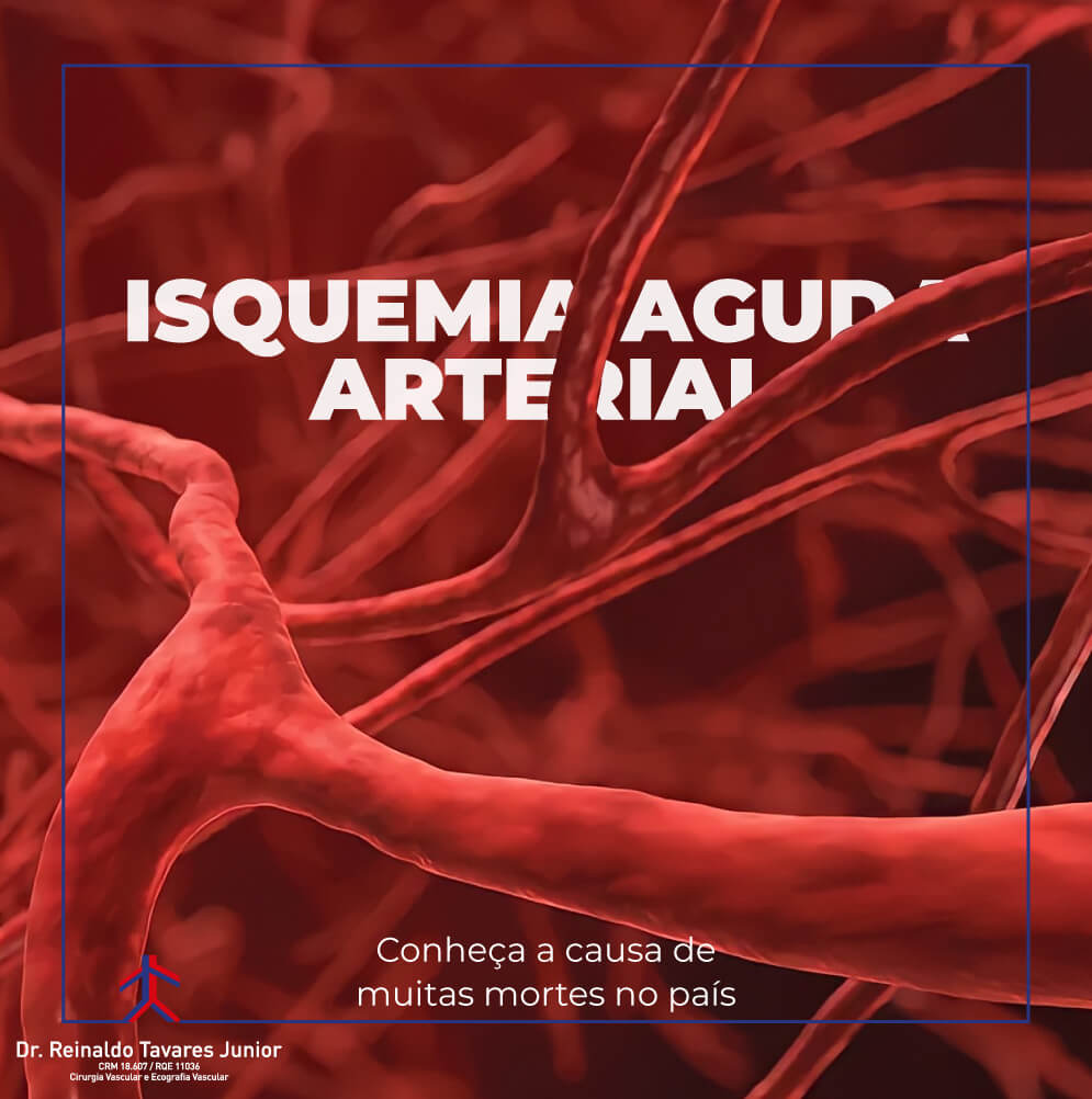 Isquemia Aguda Arterial