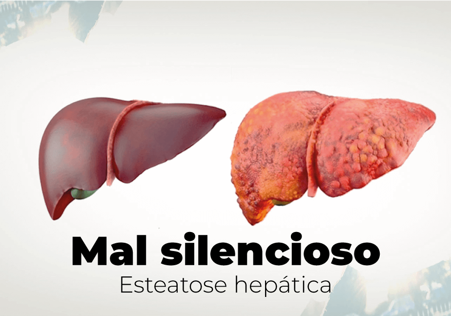 Esteatose hepática - Mal silencioso
