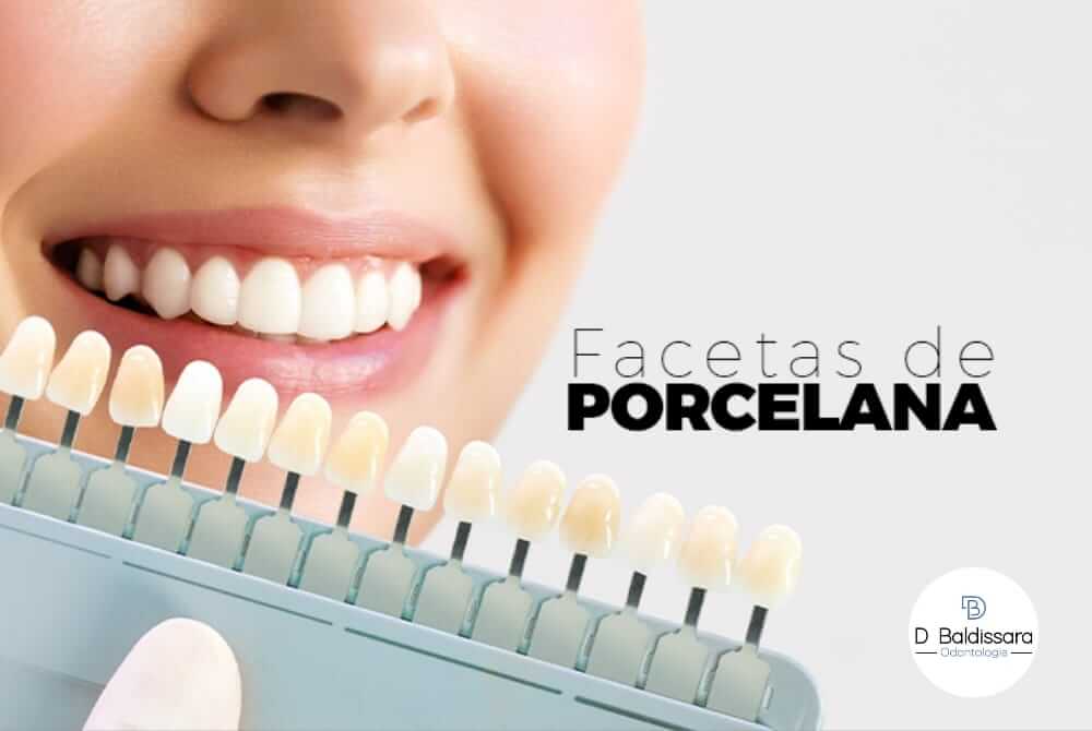 Facetas de Porcelana