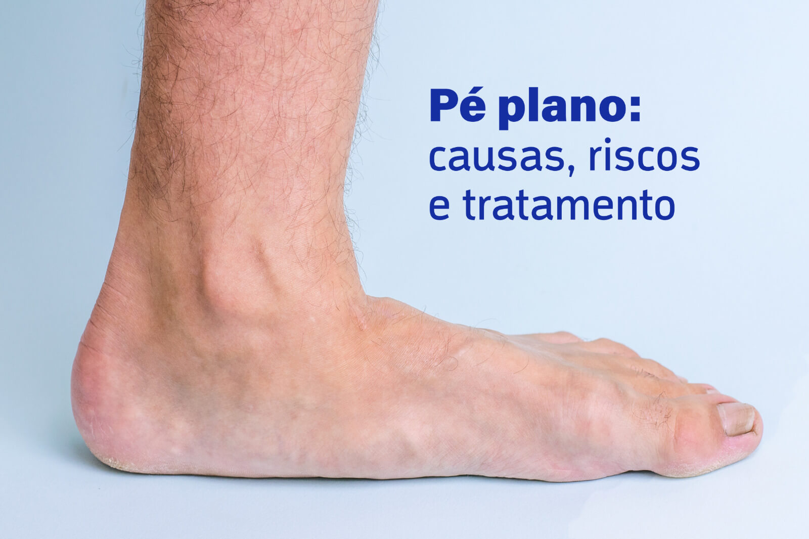 Pé plano: causas, riscos e tratamento - Ortopedista Umuarama