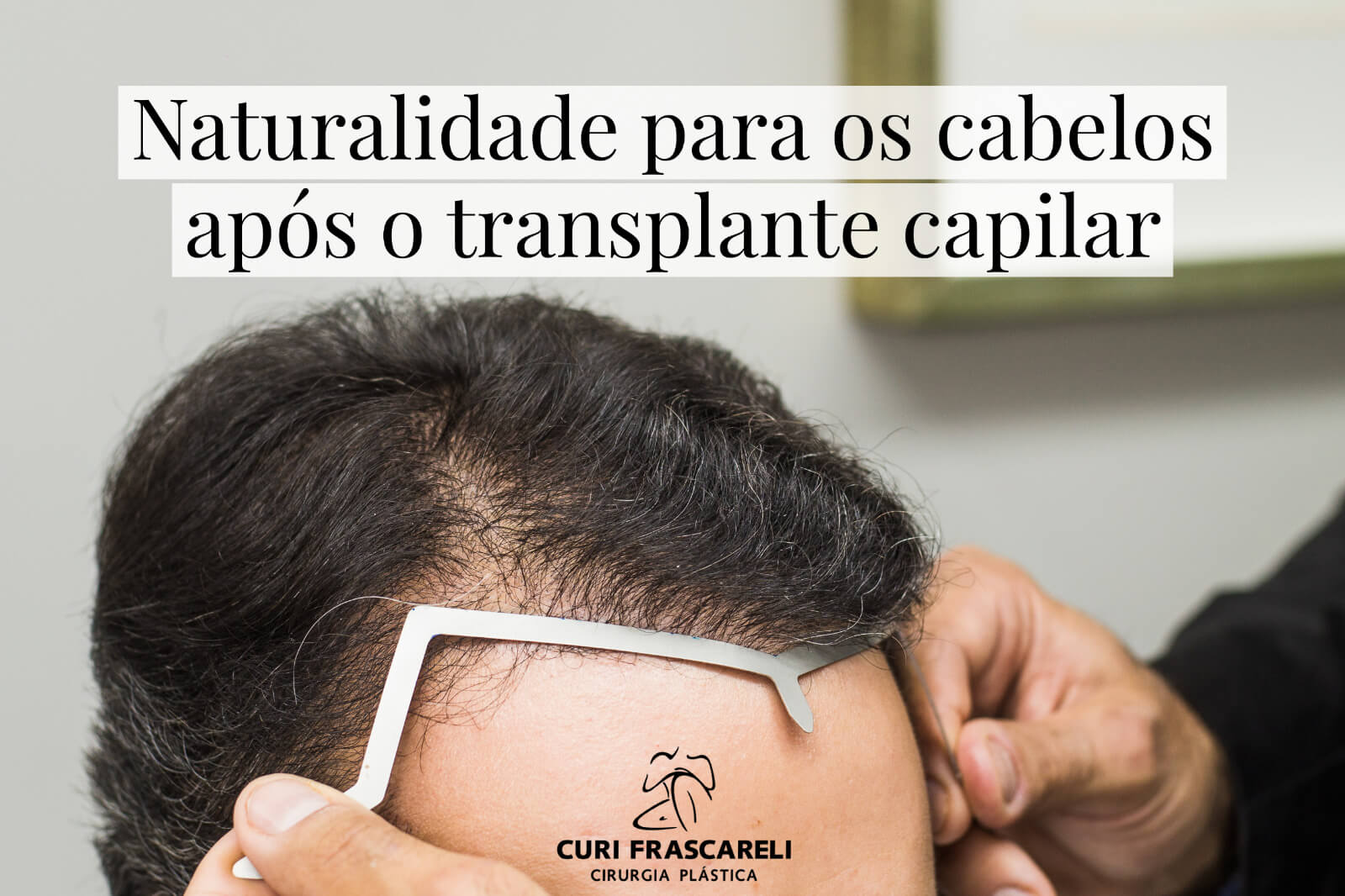 Naturalidade para os cabelos após o transplante capilar