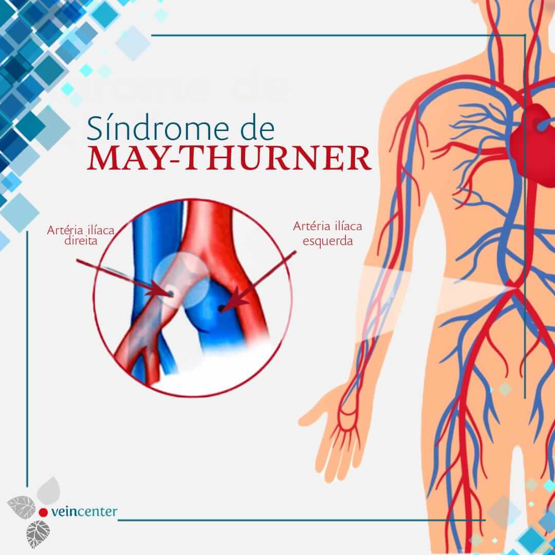 Síndrome de May-Thurner