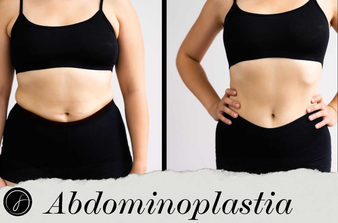 Abdominoplastia