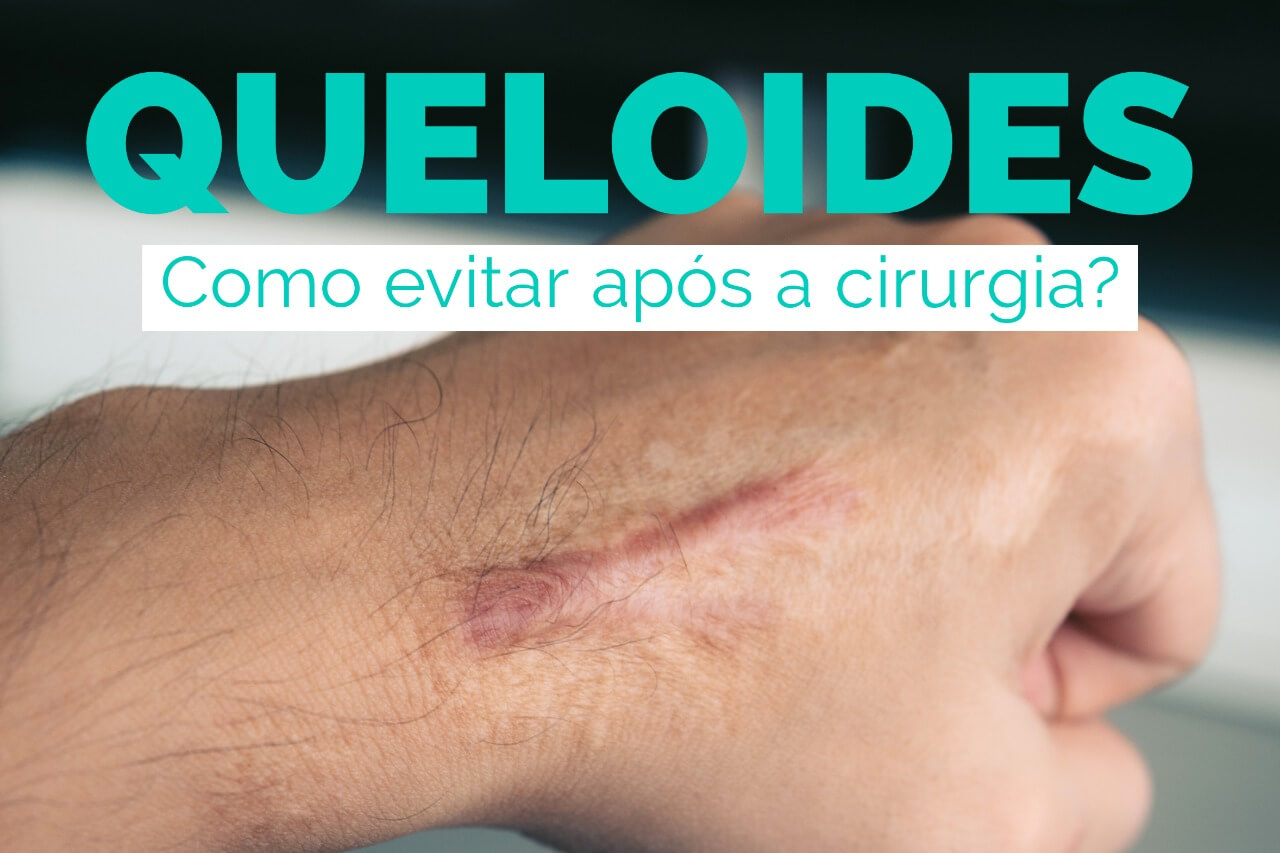 Queloides, como evitá-las após uma cirurgia? - Guia Saúde Cidades