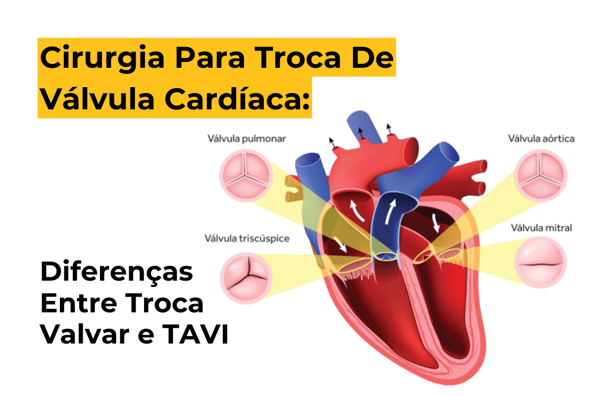 Cirurgia Para Troca De Válvula Cardíaca Maringá: Diferenças Entre Troca Valvar e TAVI