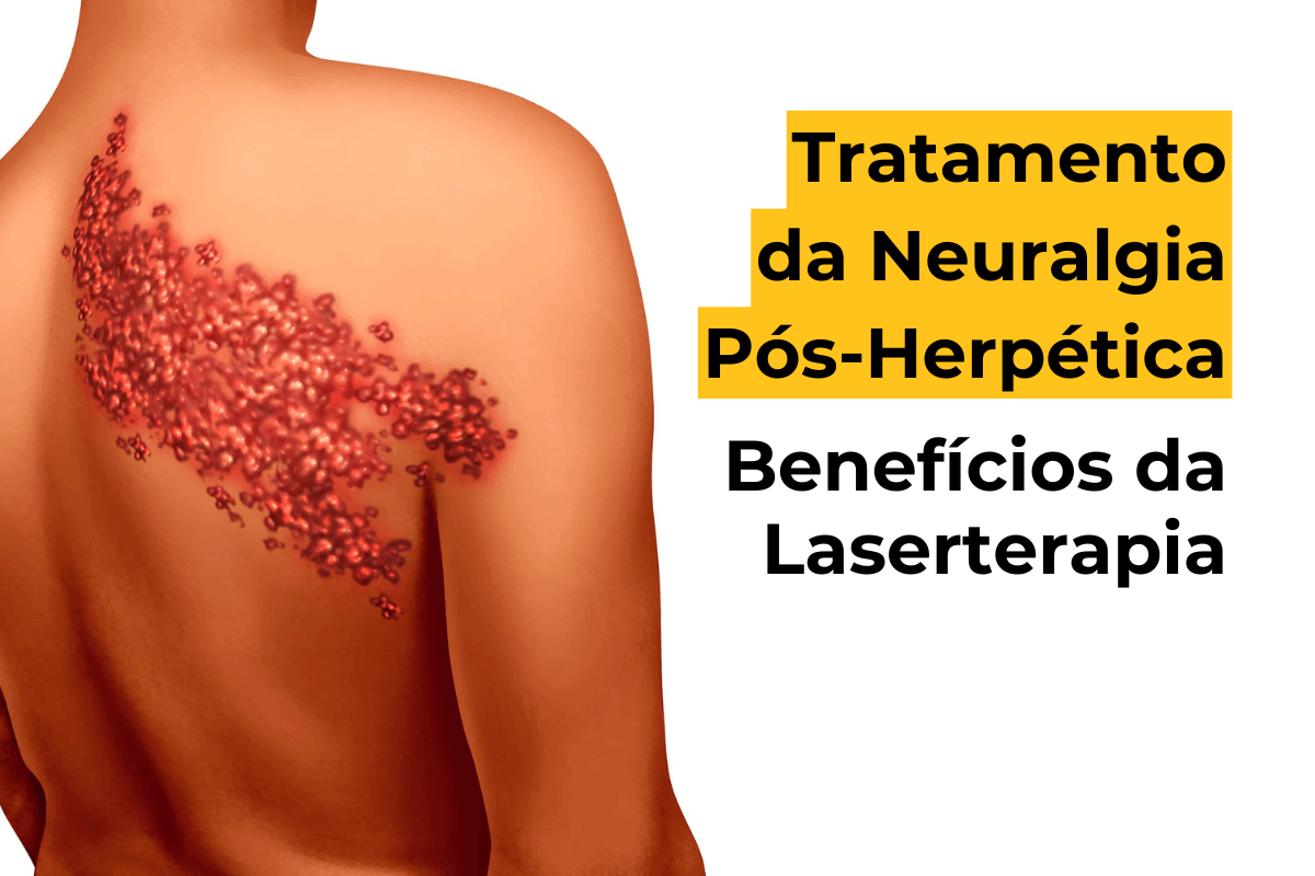Tratamento da Neuralgia Pós-Herpética em Maringá: Benefícios da Laserterapia
