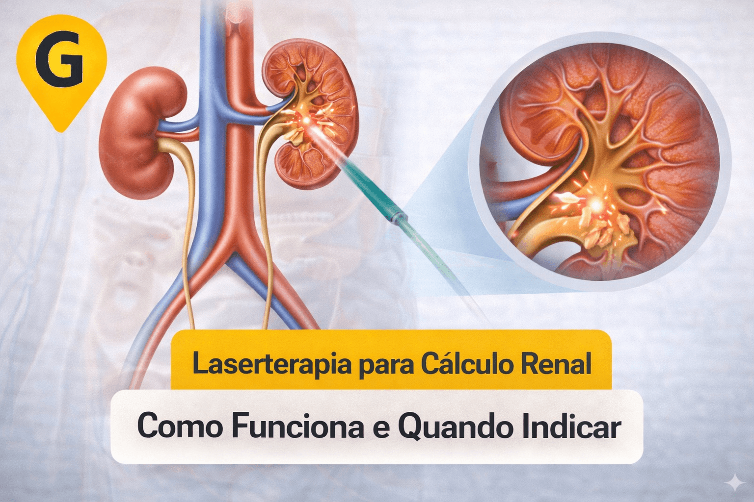 Laserterapia para Cálculo Renal em Maringá: Como Funciona e Quando Indicar