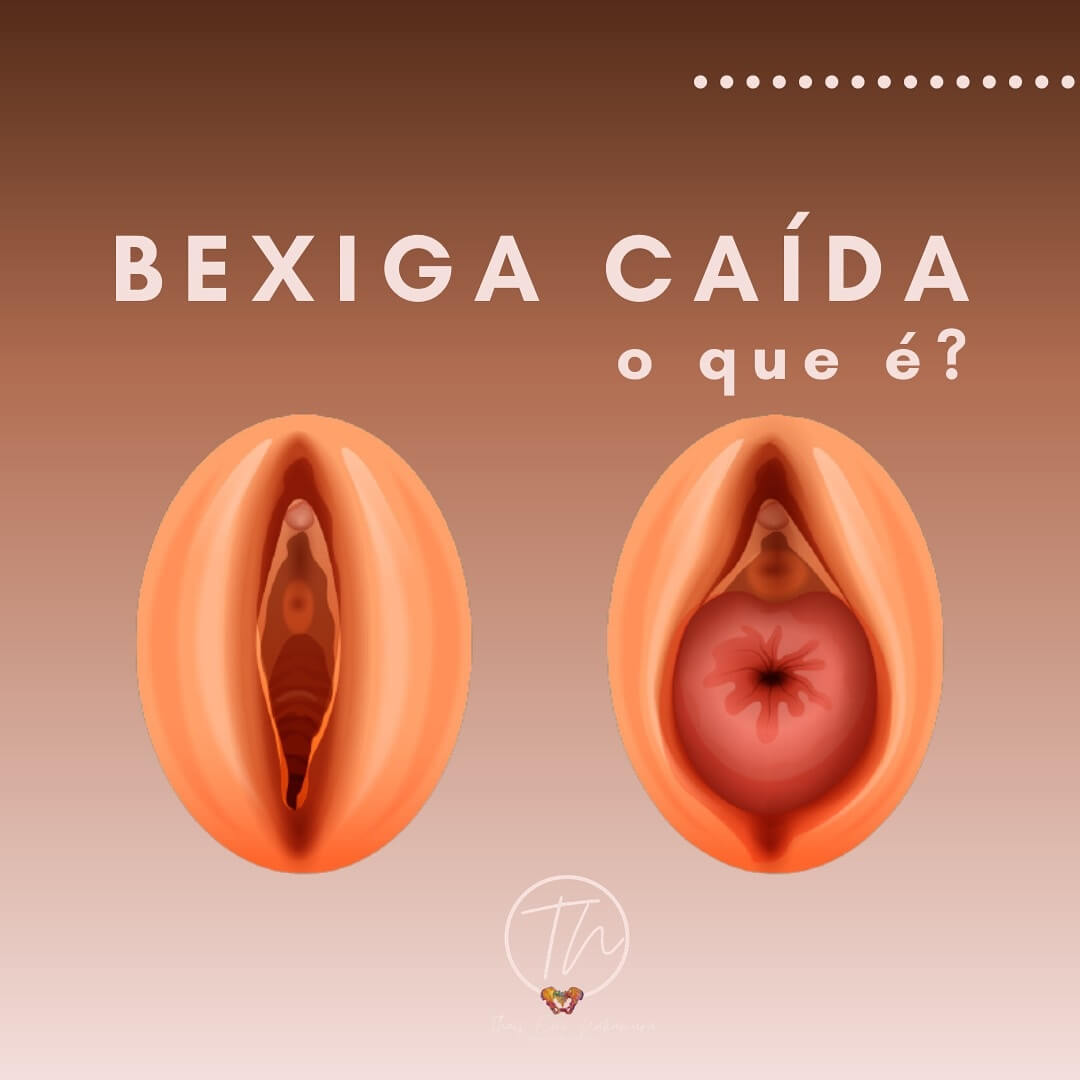 Bexiga caída, o que é?