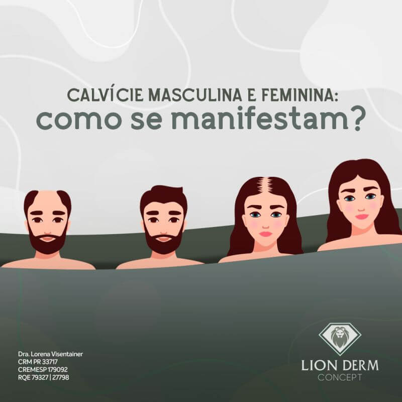 TRANSPLANTE CAPILAR: diferenças da CALVÍCIE em HOMENS x MULHERES