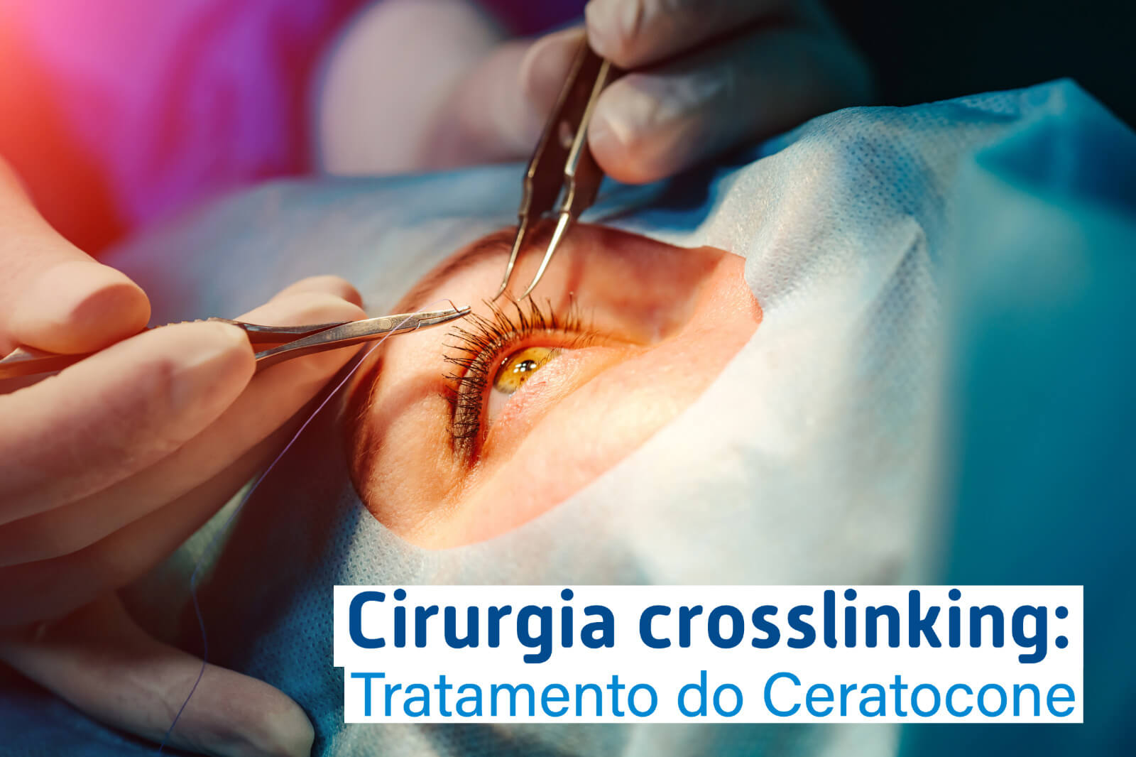 Cirurgia crosslinking: Tratamento do Ceratocone