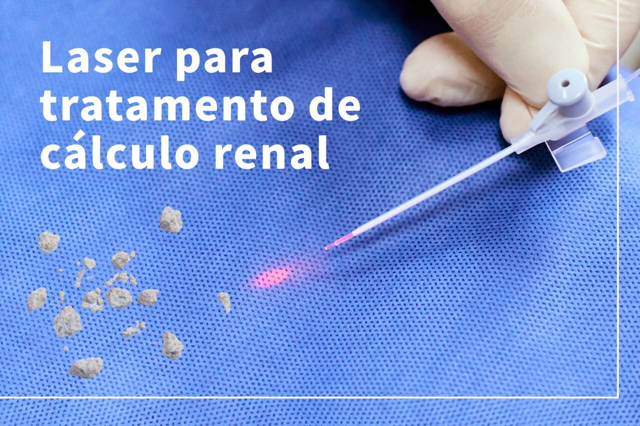 Laser para tratamento de cálculo renal