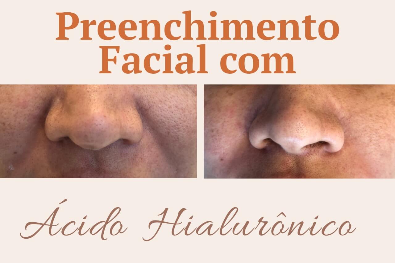 Preenchimento Facial com Ácido Hialurônico