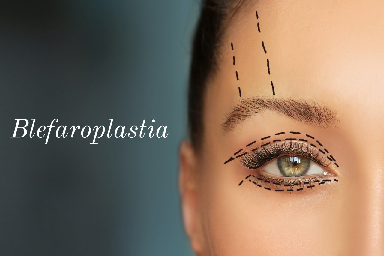 Blefaroplastia