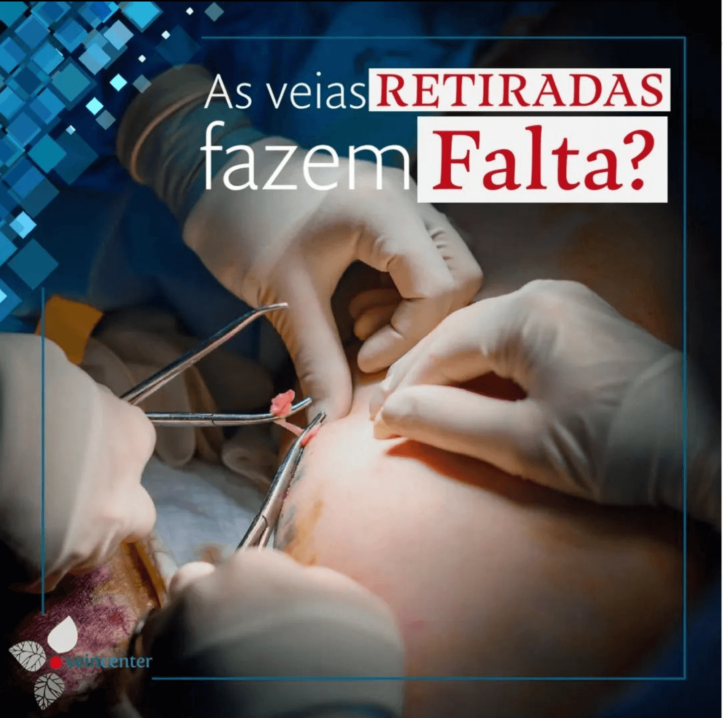 As veias retiradas fazem falta?