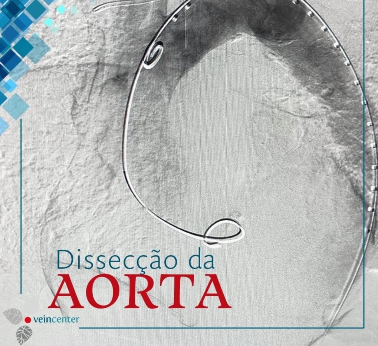 Dissecção da aorta