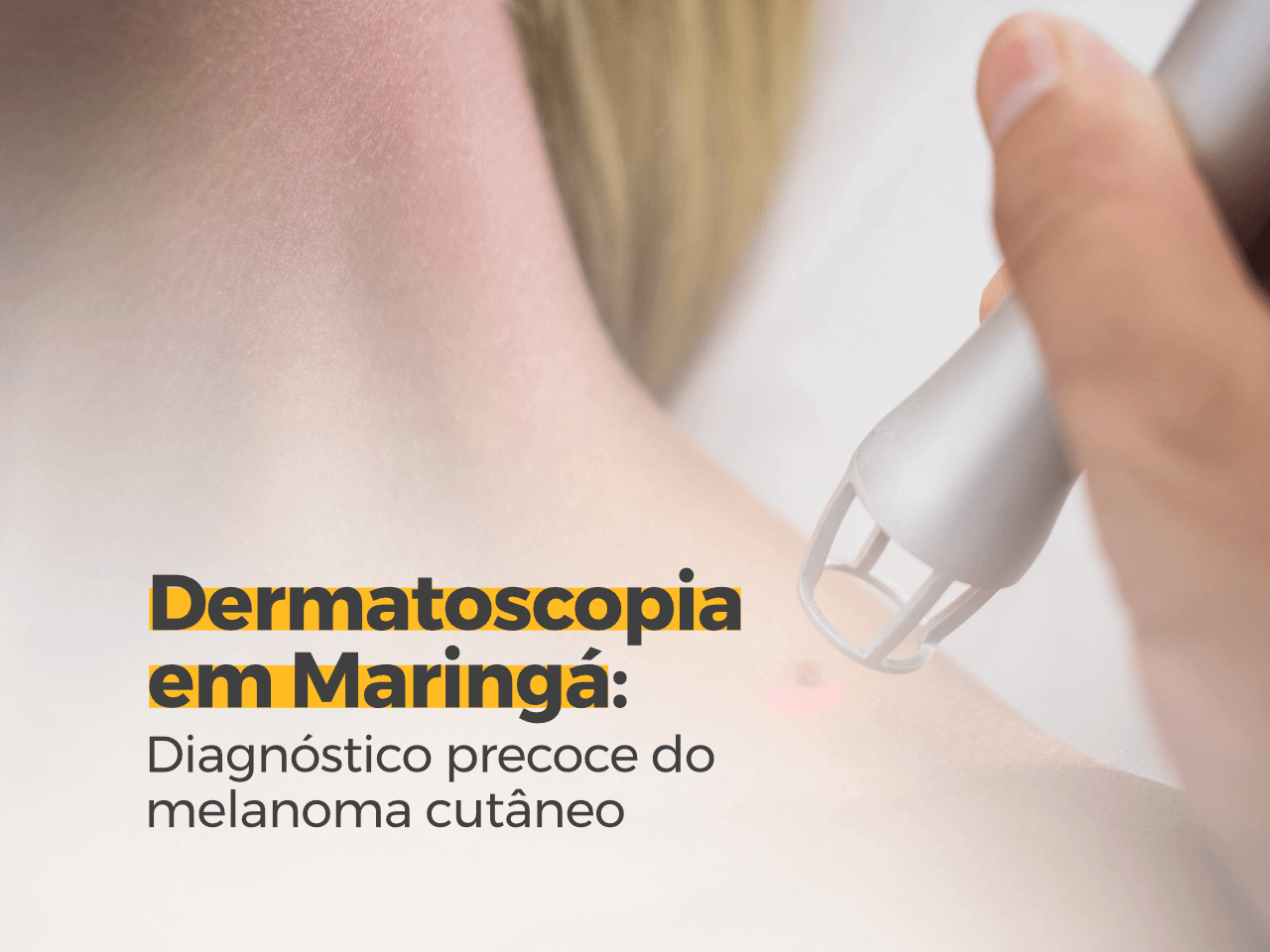 Dermatoscopia em Maringá: Diagnóstico Precoce do Melanoma Cutâneo