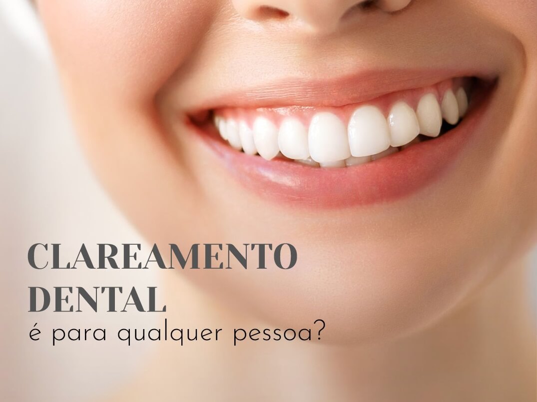 Clareamento dental é para qualquer pessoa?