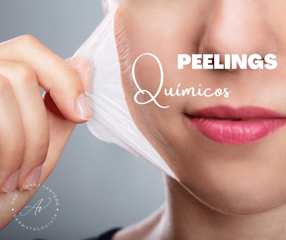  Peelings químicos