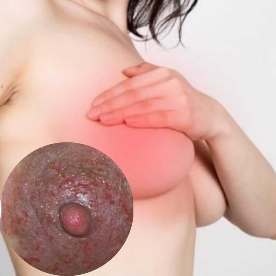 Câncer de mama: Como a dermatologia pode ajudar nessa causa?