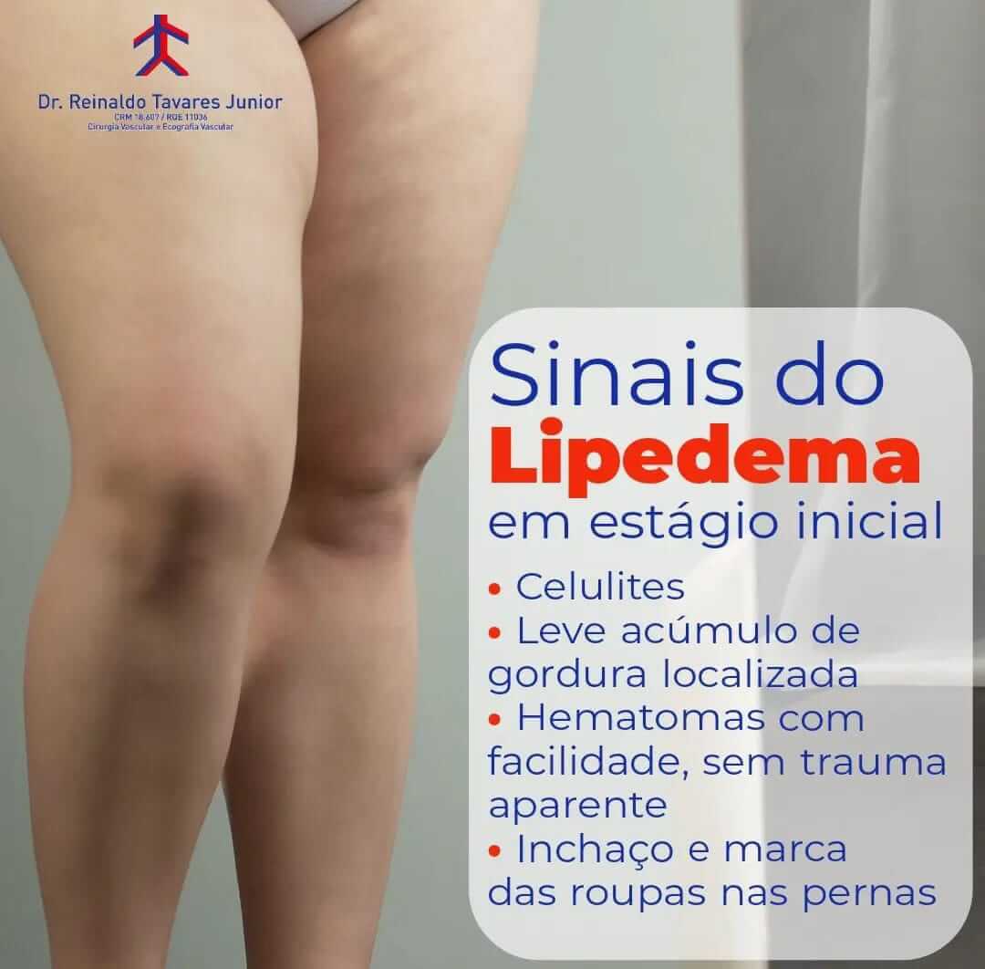 LIPEDEMA ou GORDURA LOCALIZADA - Diferenças e O QUE FAZER! 