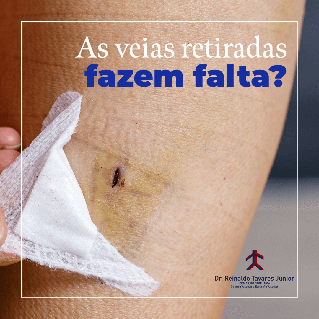 As veias retiradas fazem falta?