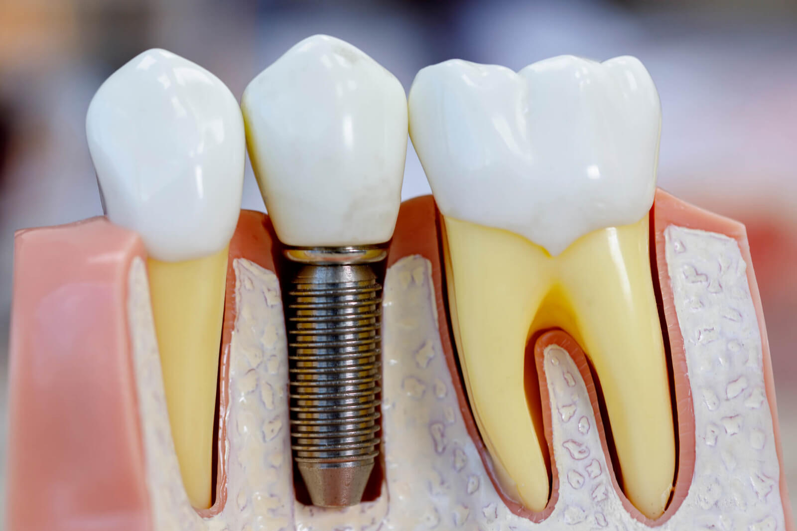 Tratamento com Implante Dentário em Maringá: Recupere Seu Sorriso com Segurança