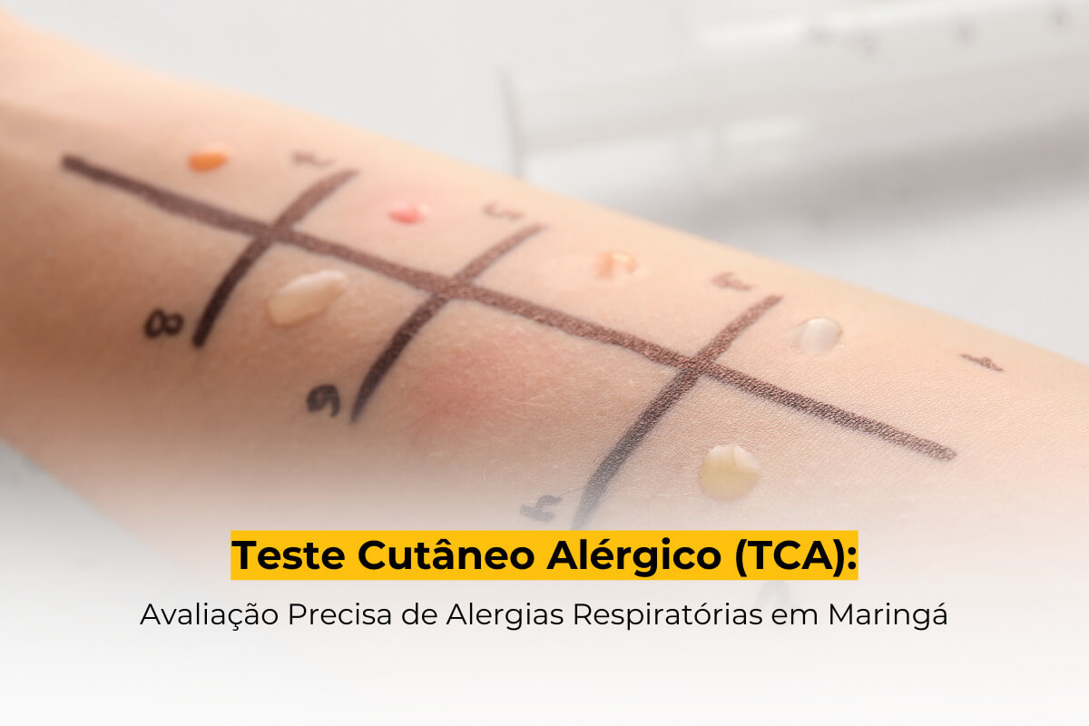 Teste Cutâneo Alérgico (TCA): Avaliação Precisa de Alergias Respiratórias em Maringá
