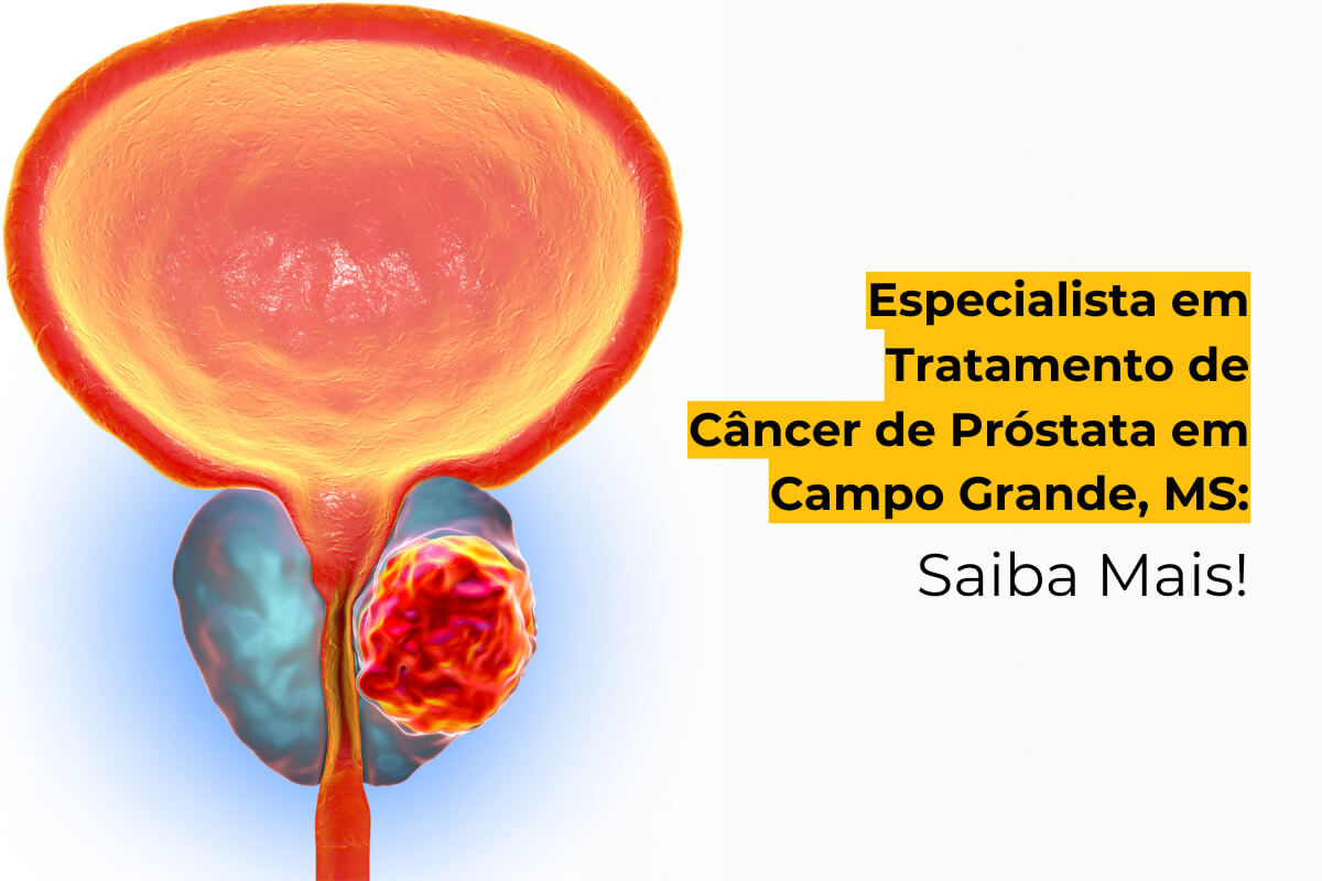 Especialista em Tratamento de Câncer de Próstata em Campo Grande, MS: Saiba Mais!