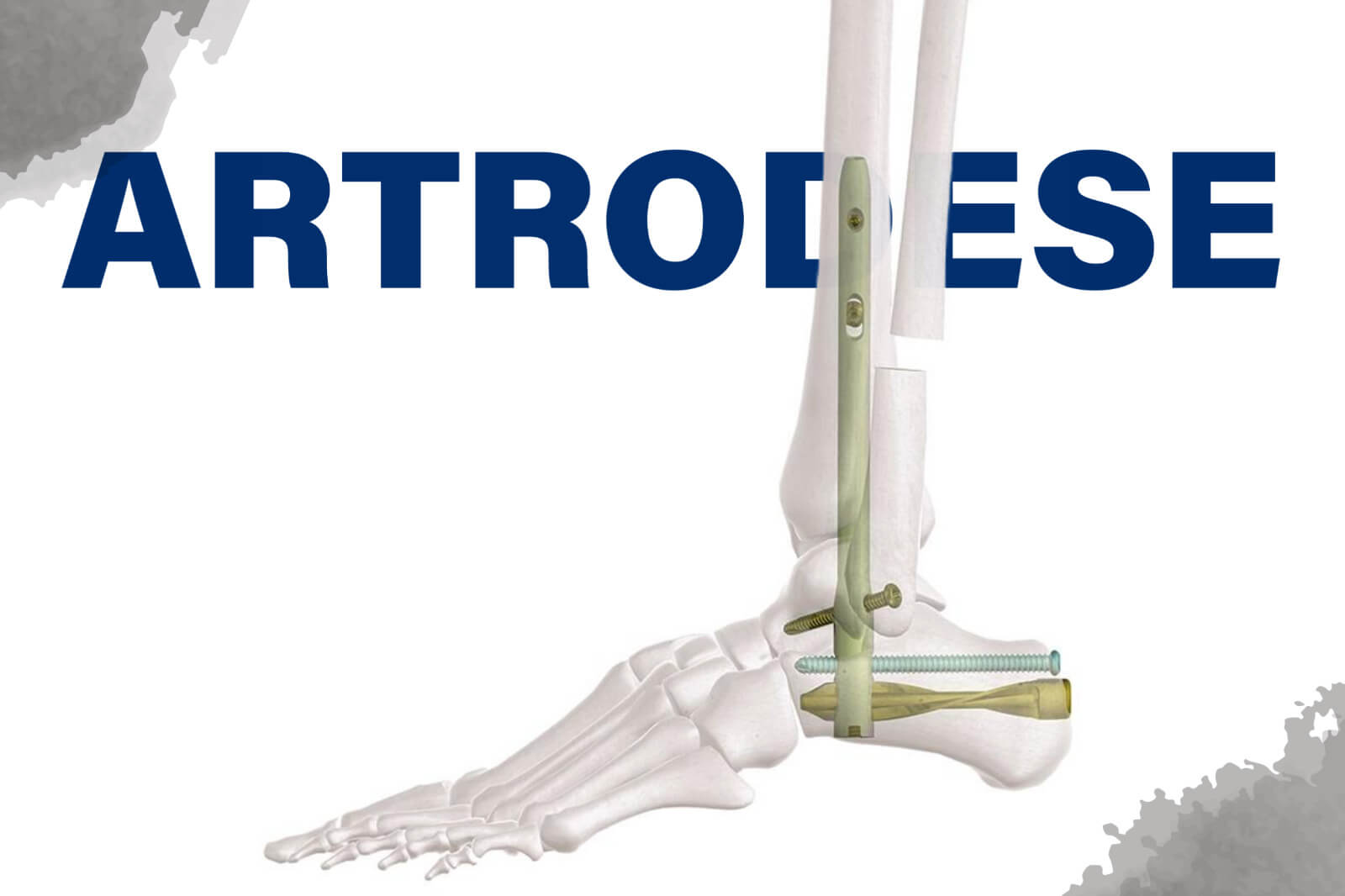 Artrodese