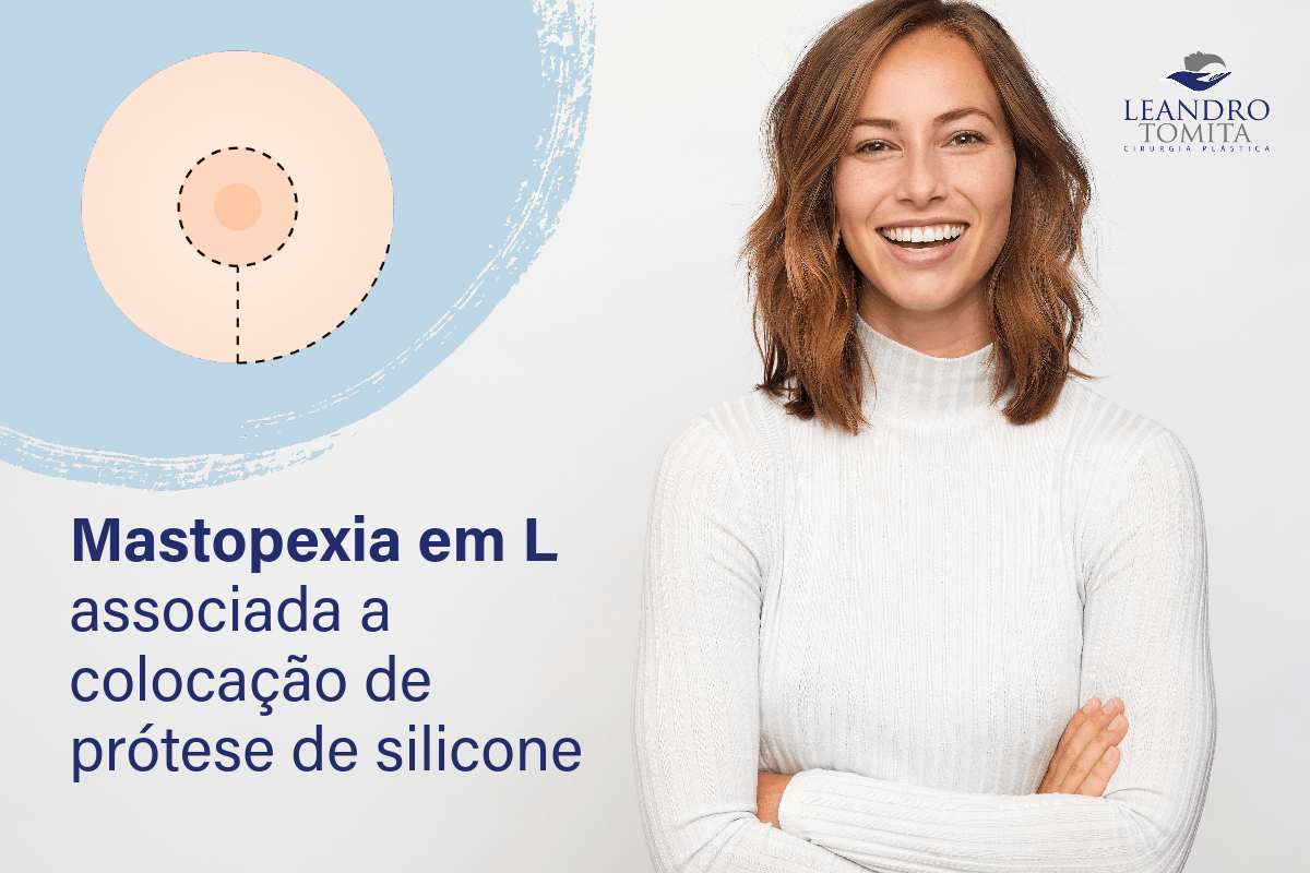 Mastopexia em L associada a colocação de prótese de silicone