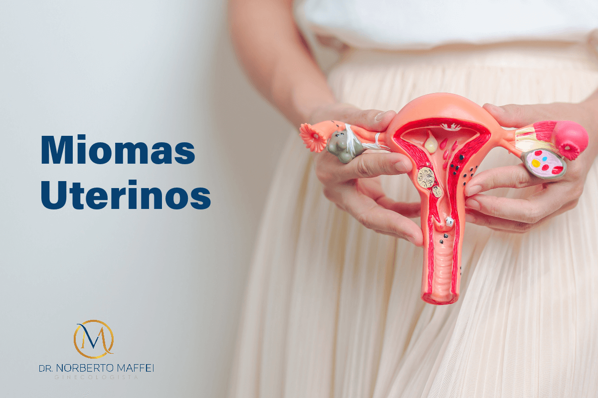 Miomas Uterinos