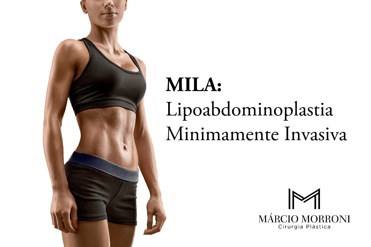 MILA: Lipoabdominoplastia Minimamente Invasiva