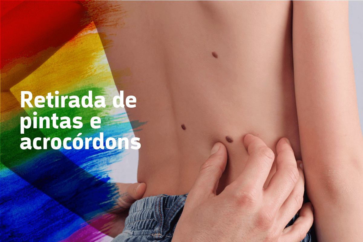 Retirada de pintas e acrocórdons