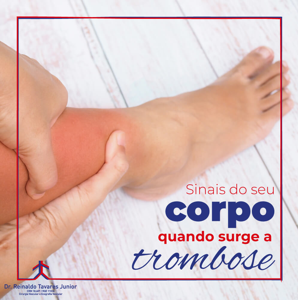 Sinais do seu corpo quando surge a trombose