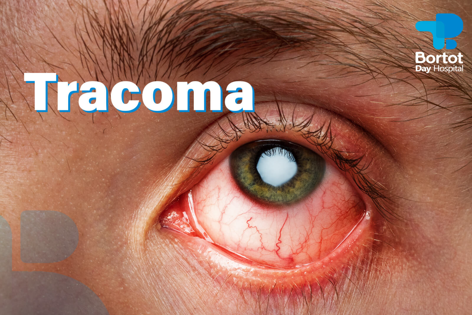 Tracoma