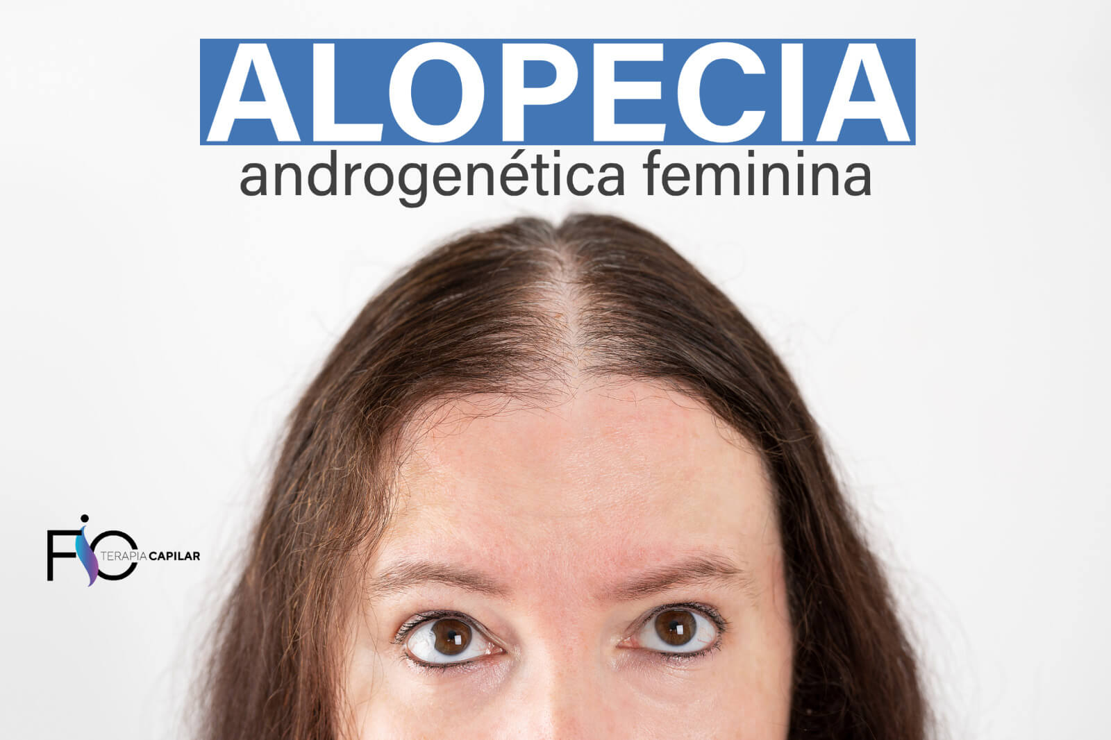Alopecia androgenética feminina