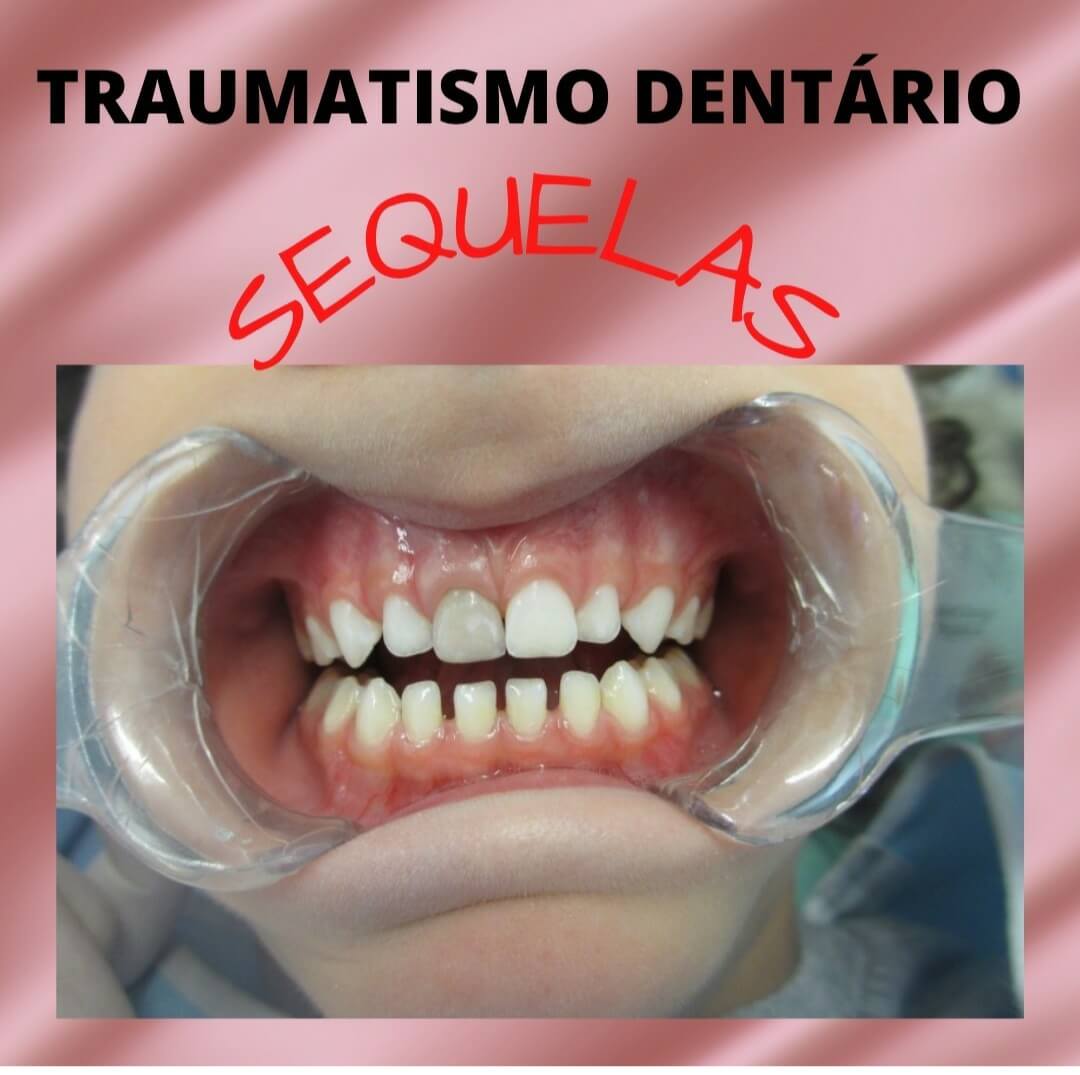 Traumatismo Dentário 
