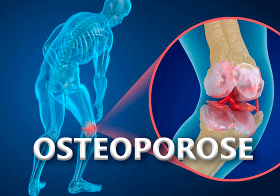 OSTEOPOROSE