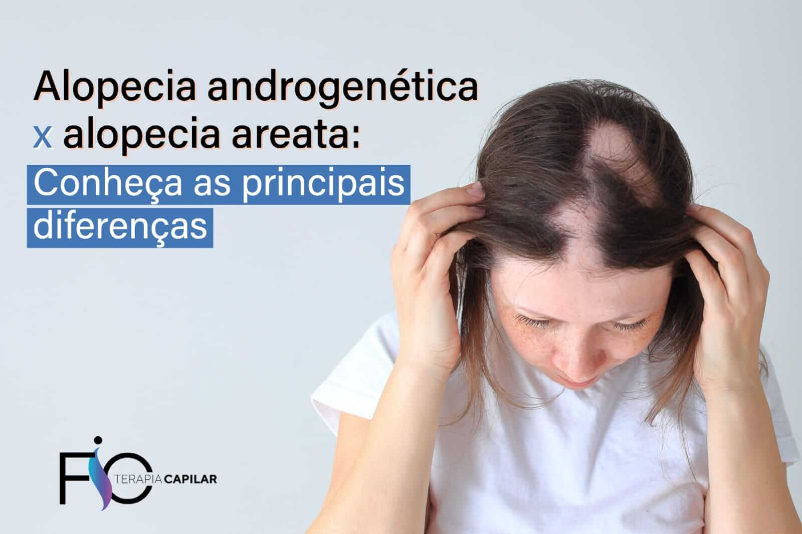 Alopecia androgenética x alopecia areata: Conheça as principais diferenças