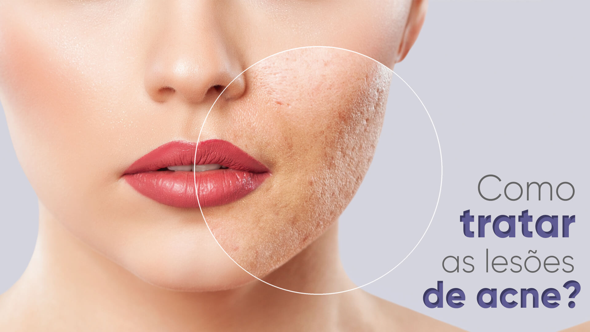 Cicatriz de acne: Quais tratamentos podem amenizar?