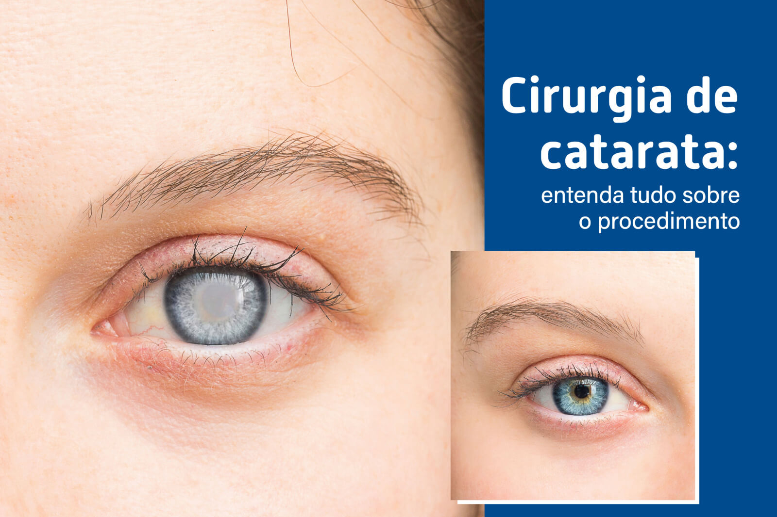 Cirurgia de catarata: entenda tudo sobre o procedimento